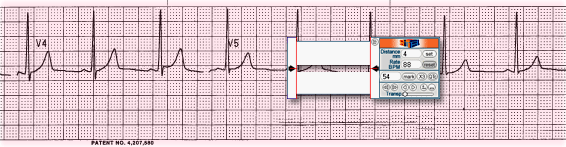 Screen Calipers measuring an EKG
